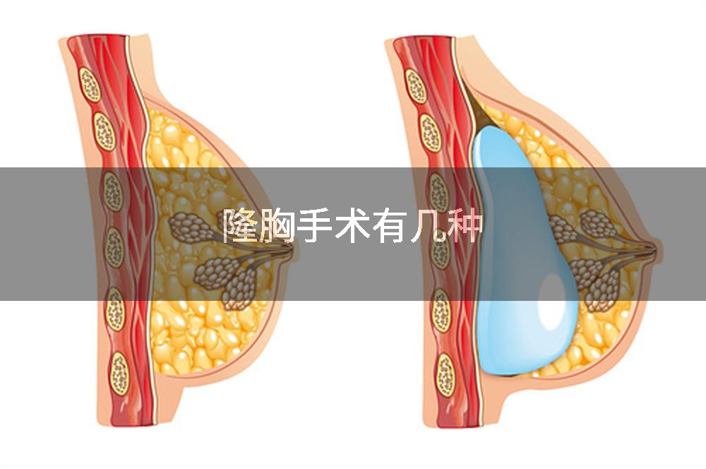 隆胸手术有几种