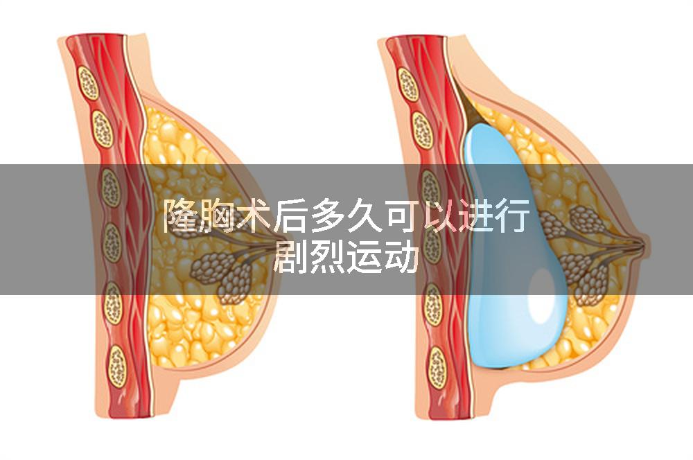 隆胸术后多久可以进行剧烈运动