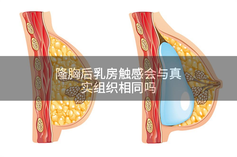 隆胸后乳房触感会与真实组织相同吗