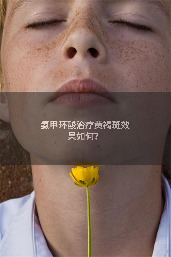 氨甲环酸治疗黄褐斑效果如何？