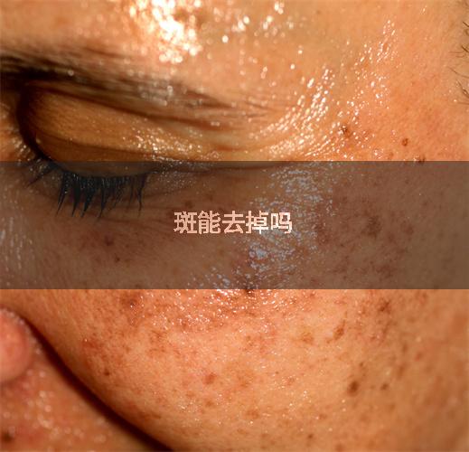 斑能去掉吗