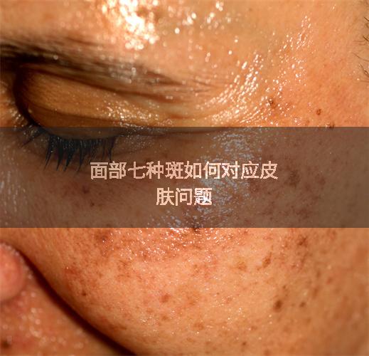 面部七种斑如何对应皮肤问题