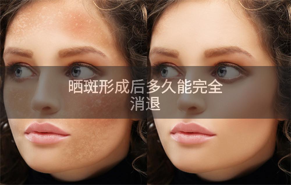 晒斑形成后多久能完全消退