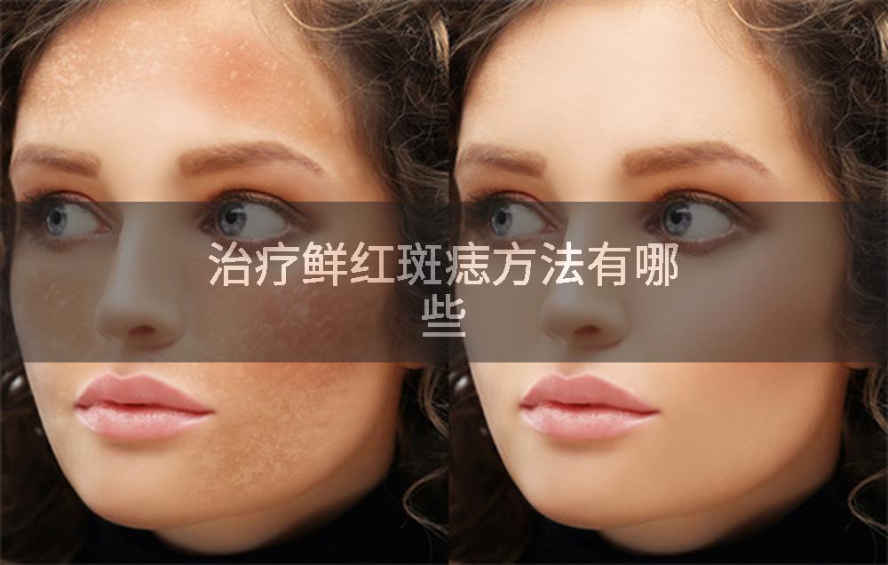 治疗鲜红斑痣方法有哪些