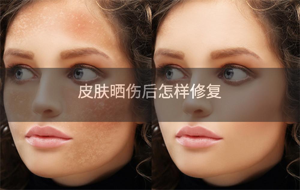 皮肤晒伤后怎样修复