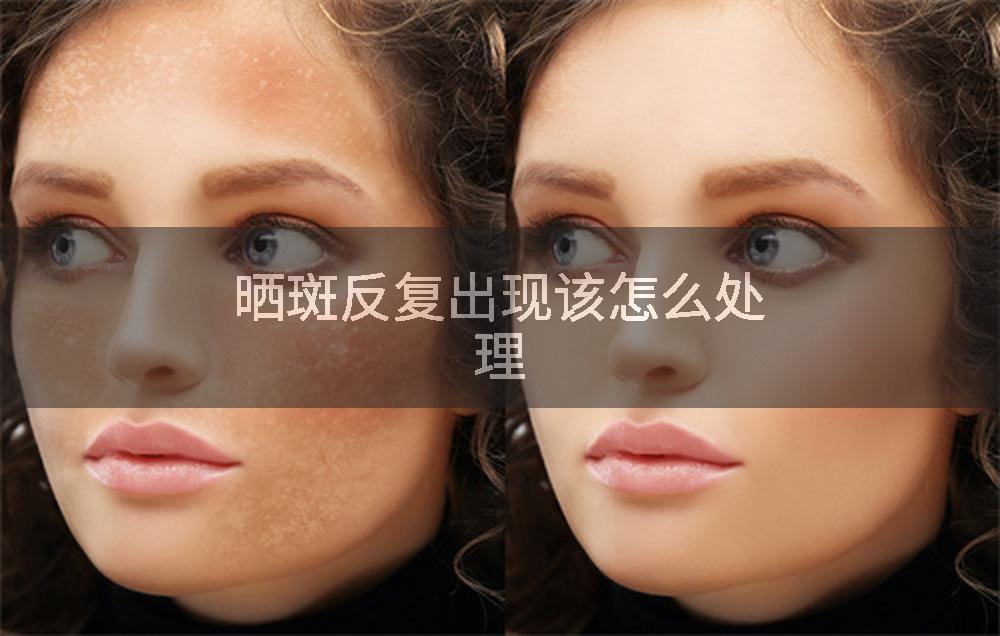 晒斑反复出现该怎么处理
