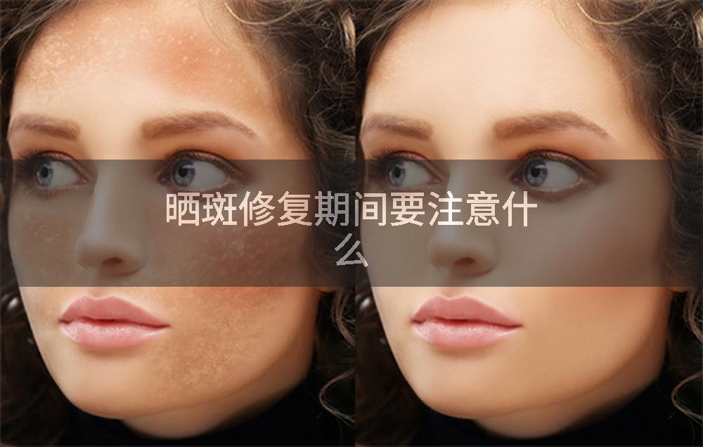 晒斑修复期间要注意什么