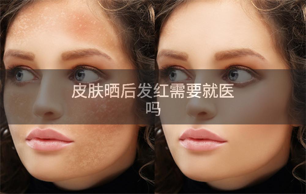 皮肤晒后发红需要就医吗