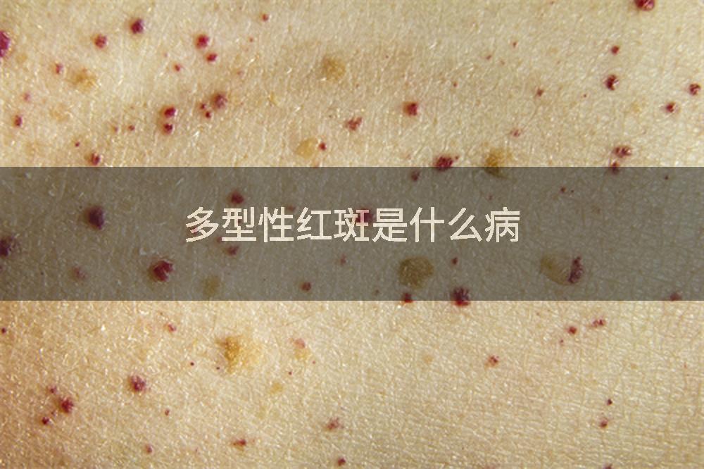 多型性红斑是什么病