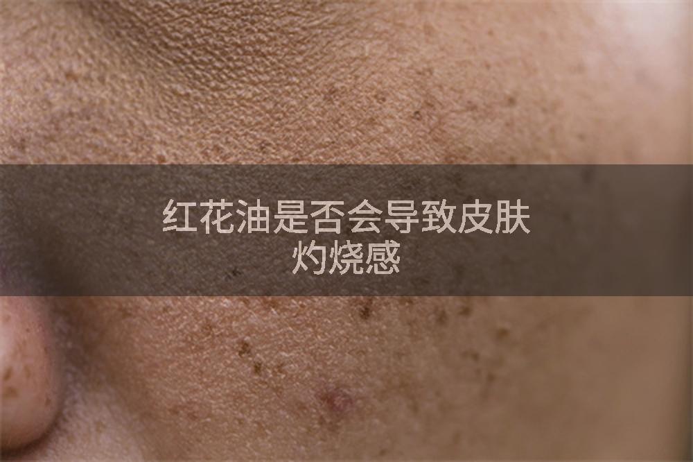红花油是否会导致皮肤灼烧感