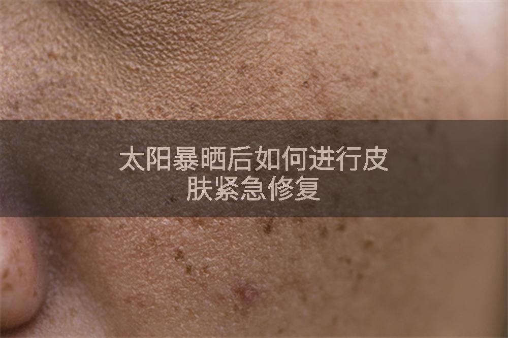 太阳暴晒后如何进行皮肤紧急修复