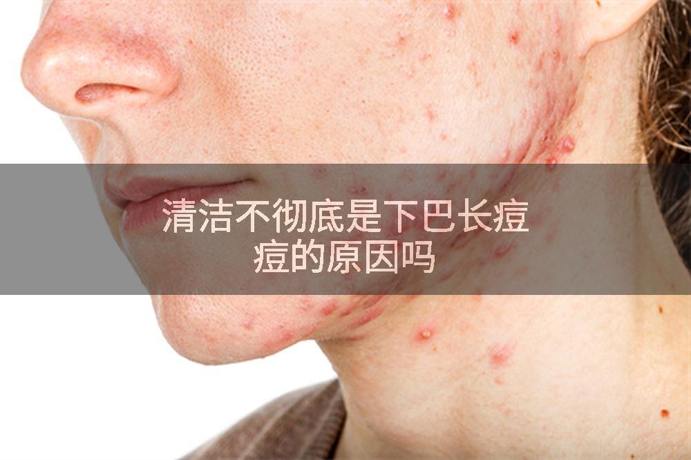清洁不彻底是下巴长痘痘的原因吗