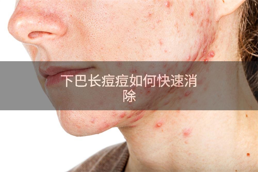 下巴长痘痘如何快速消除