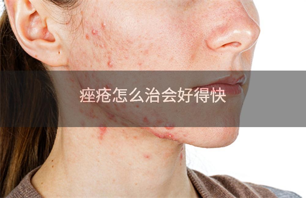 痤疮怎么治会好得快