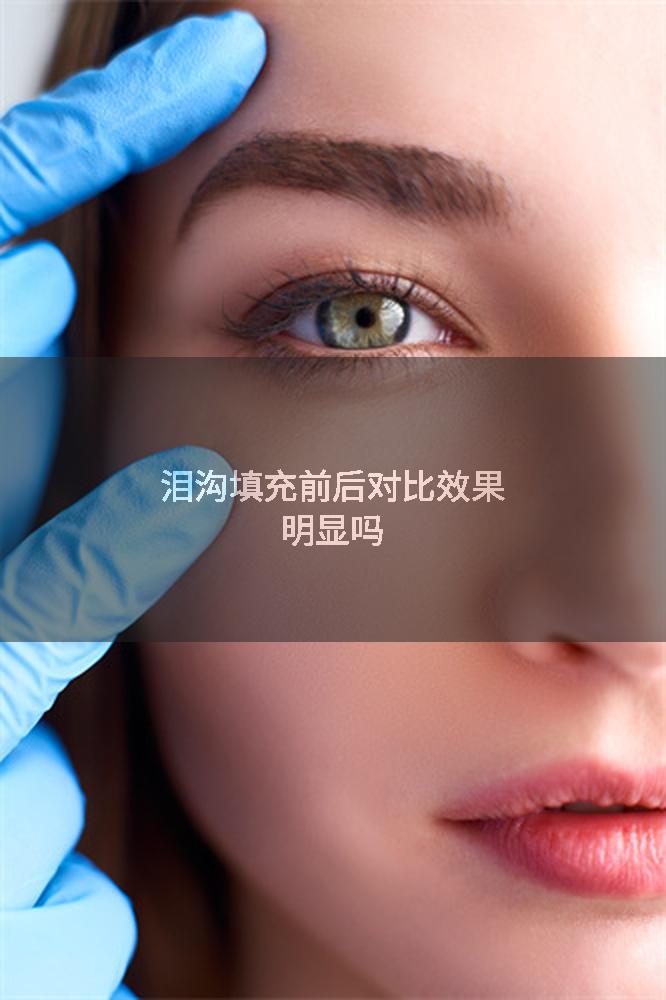 泪沟填充前后对比效果明显吗