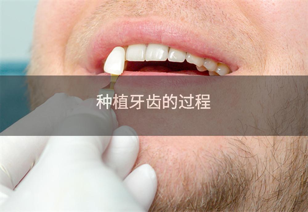 种植牙齿的过程