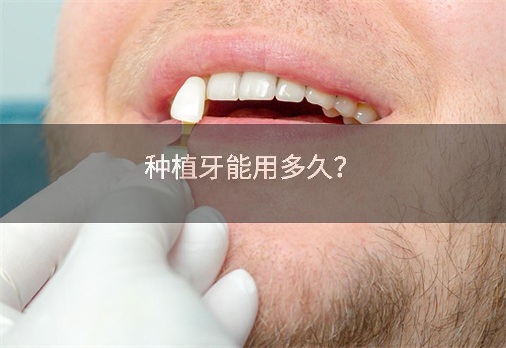 种植牙能用多久？