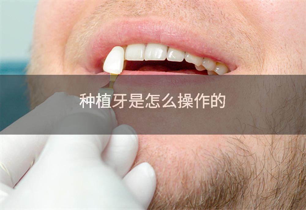 种植牙是怎么操作的
