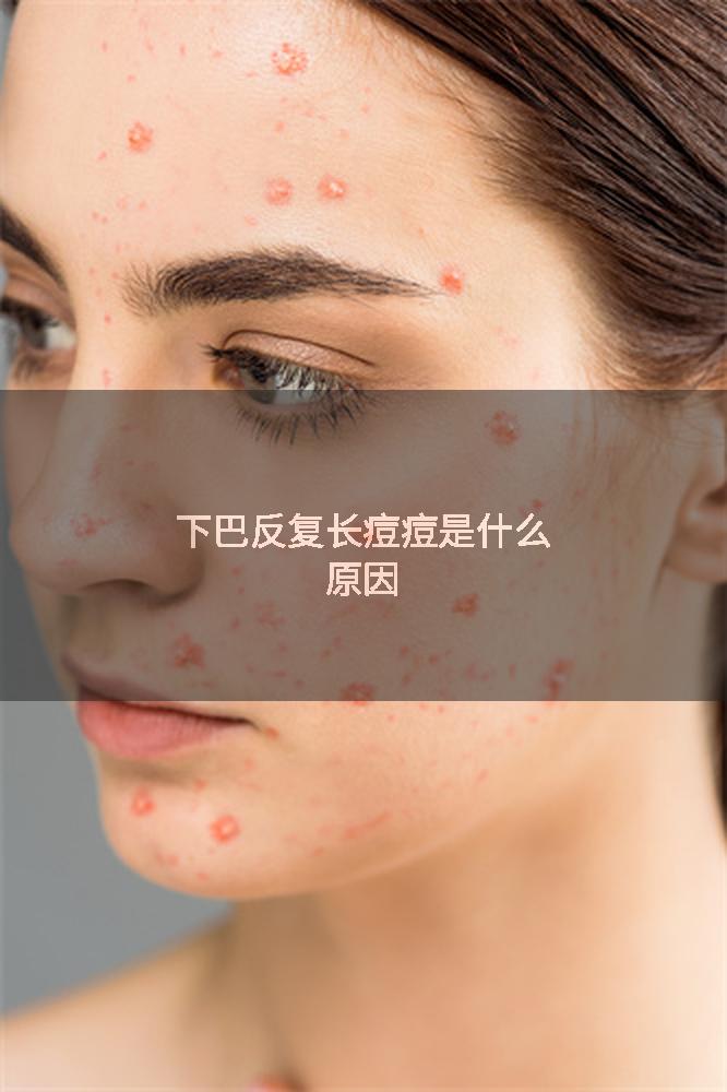 下巴反复长痘痘是什么原因