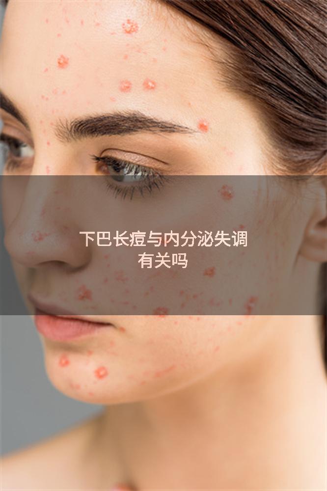 下巴长痘与内分泌失调有关吗