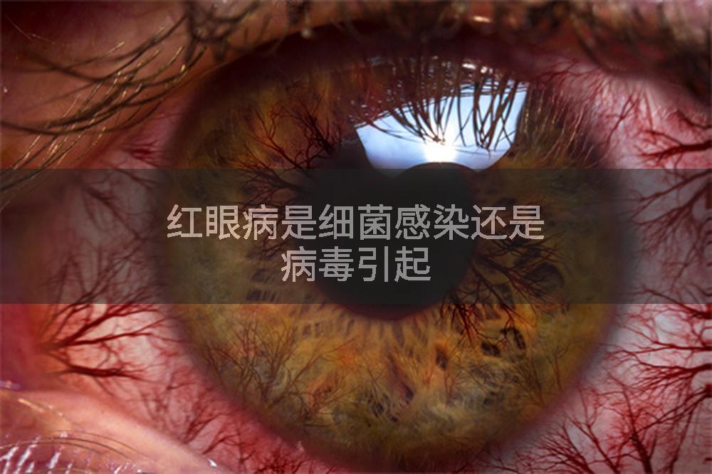 红眼病是细菌感染还是病毒引起
