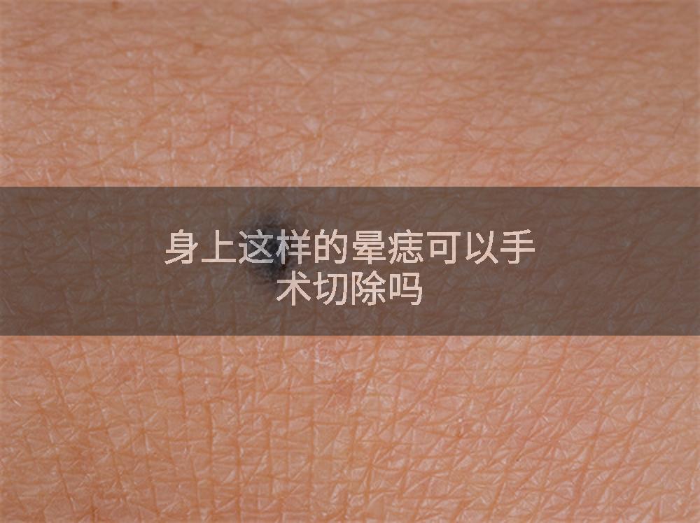 身上这样的晕痣可以手术切除吗