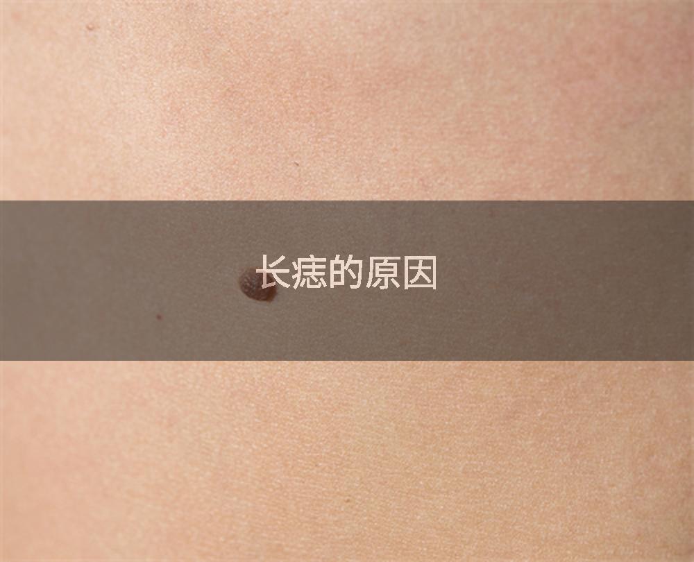 长痣的原因