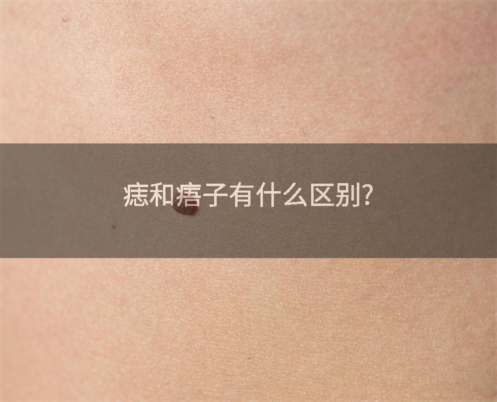 痣和痦子有什么区别?