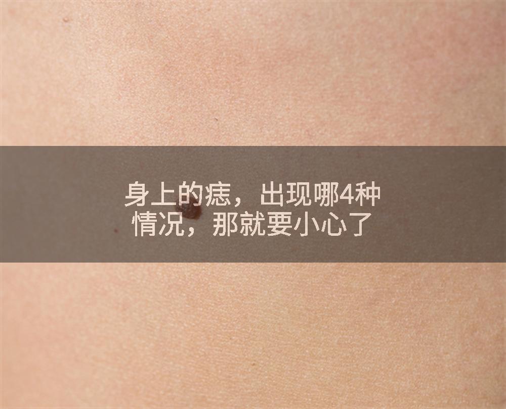 身上的痣，出现哪4种情况，那就要小心了
