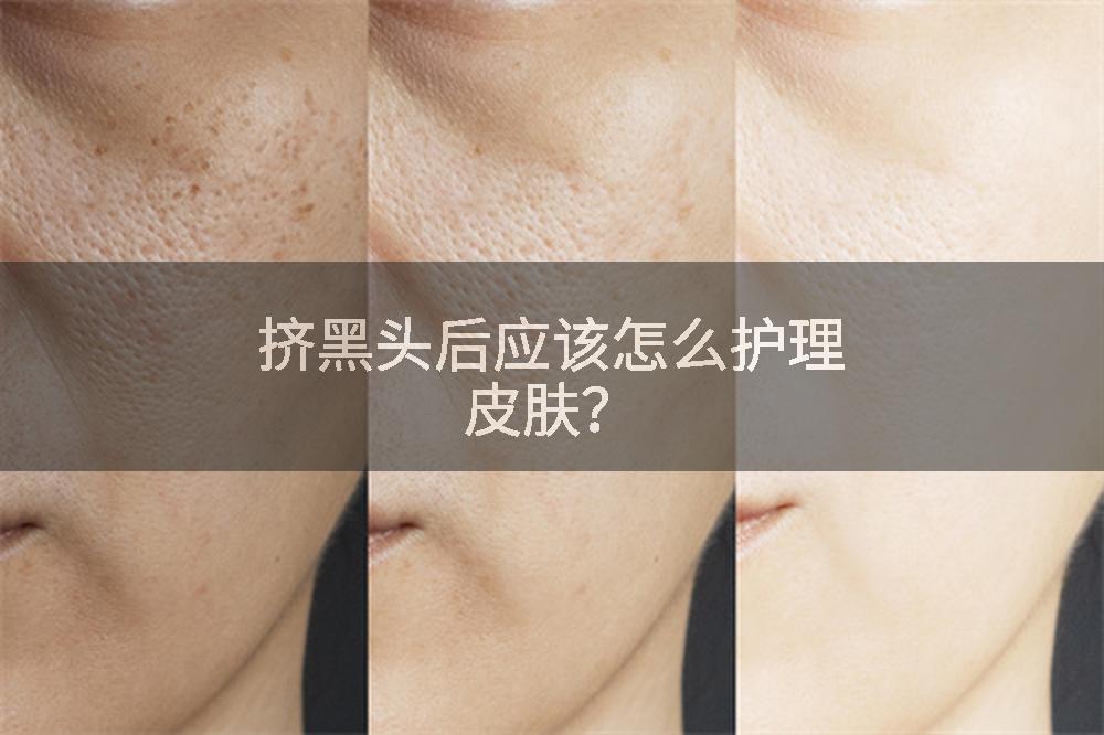 挤黑头后应该怎么护理皮肤？