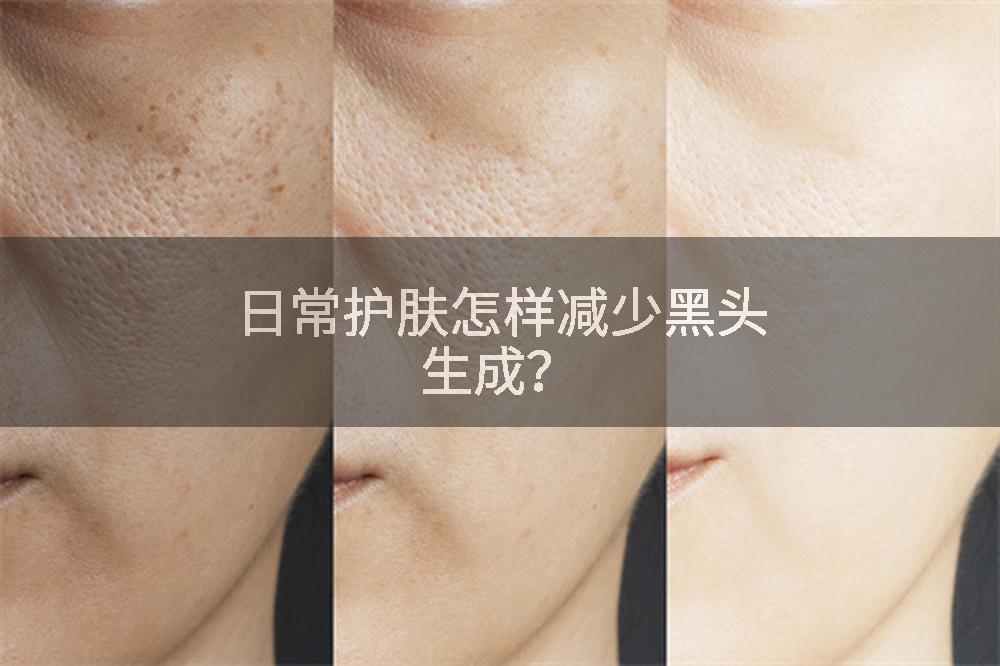 日常护肤怎样减少黑头生成？