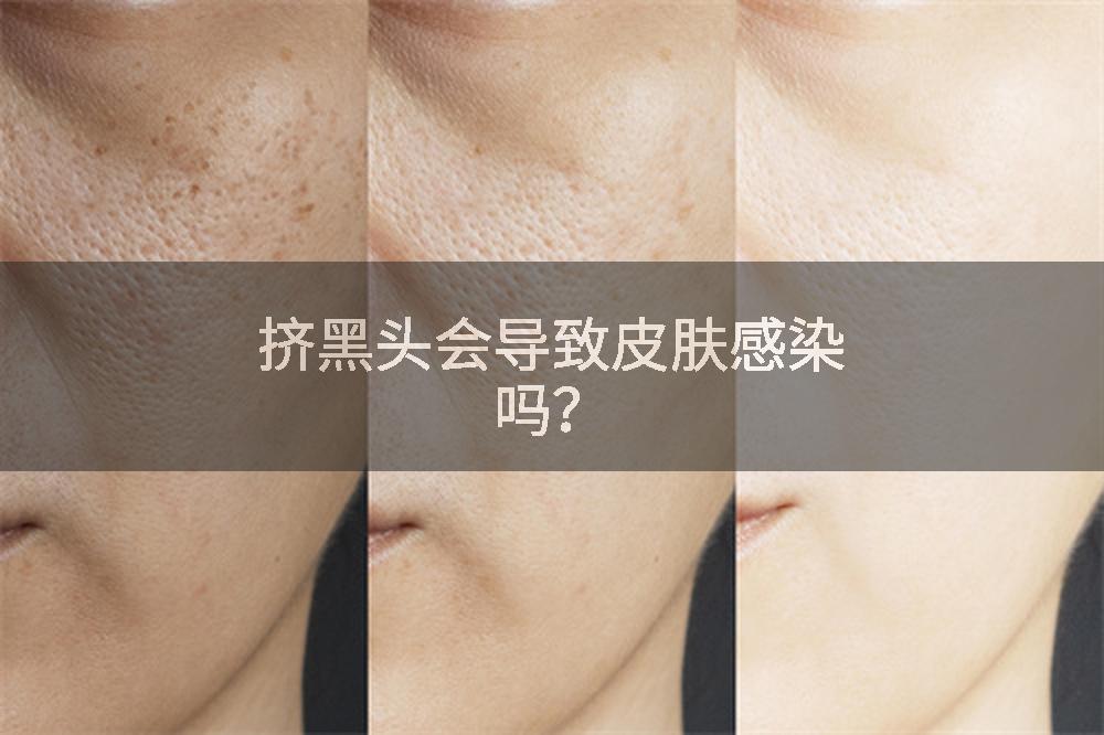 挤黑头会导致皮肤感染吗？