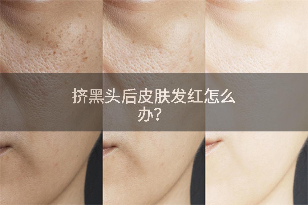 挤黑头后皮肤发红怎么办？