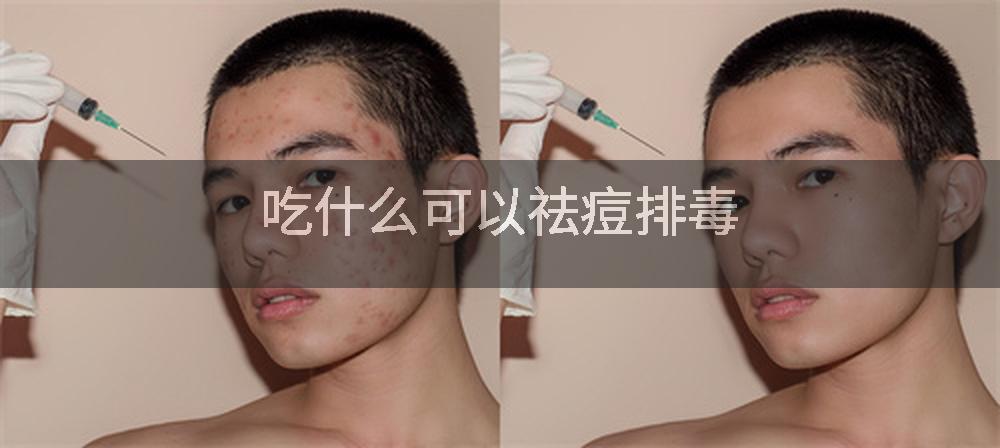 吃什么可以祛痘排毒