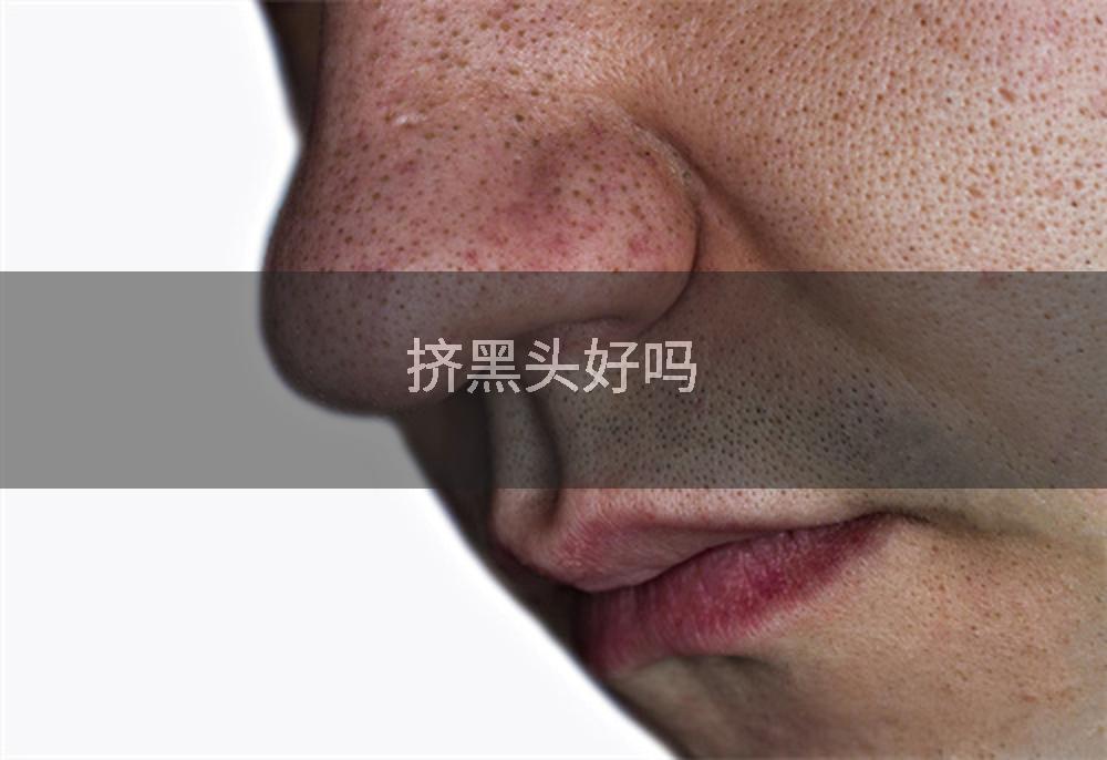 挤黑头好吗