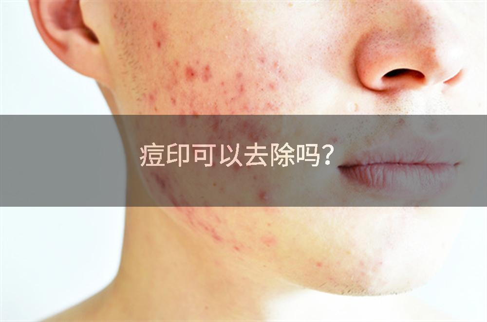 痘印可以去除吗？