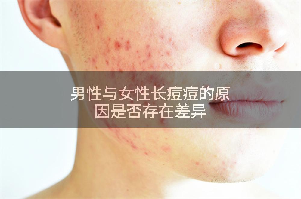 男性与女性长痘痘的原因是否存在差异