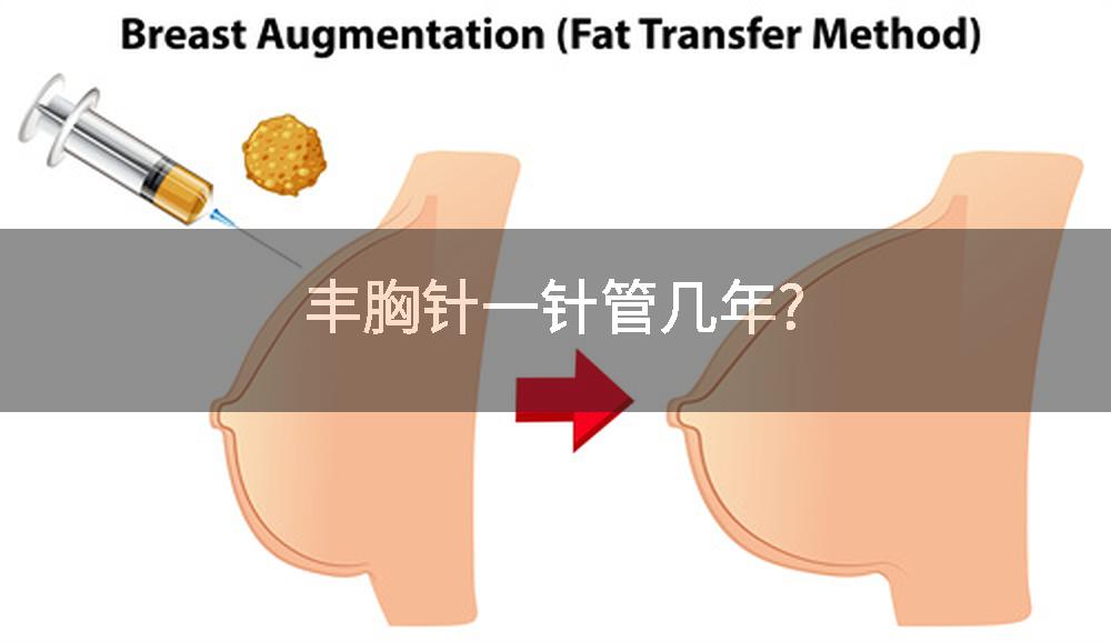 丰胸针一针管几年?