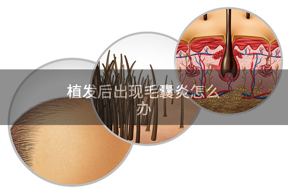 植发后出现毛囊炎怎么办