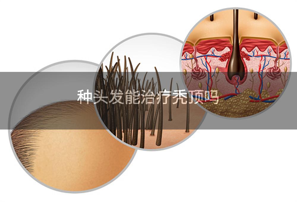 种头发能治疗秃顶吗