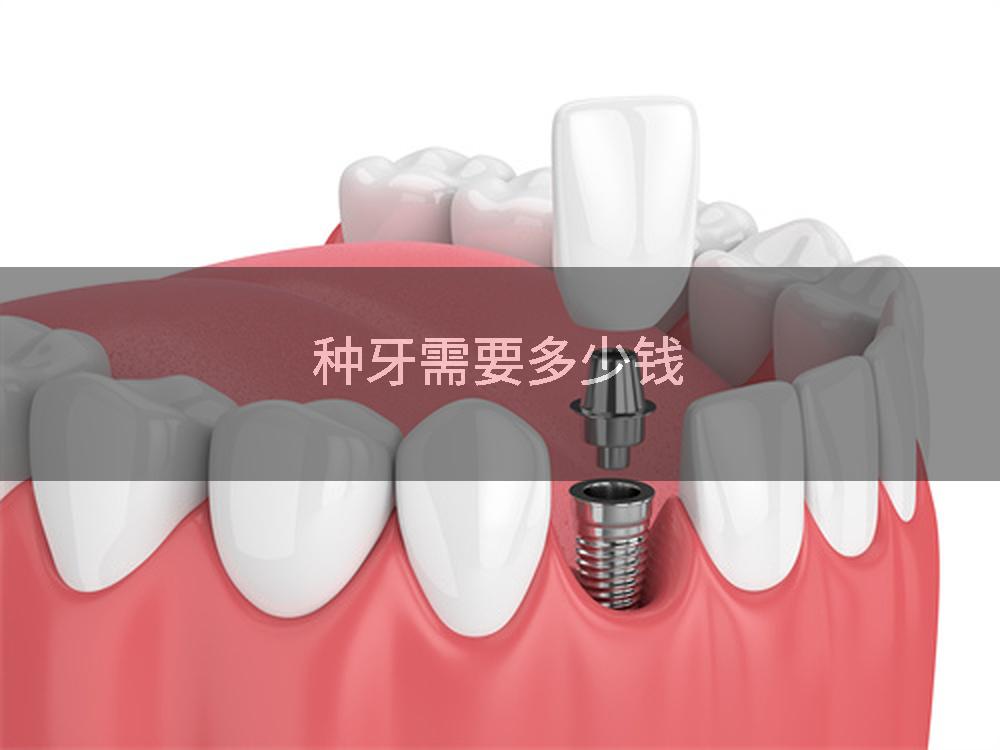 种牙需要多少钱