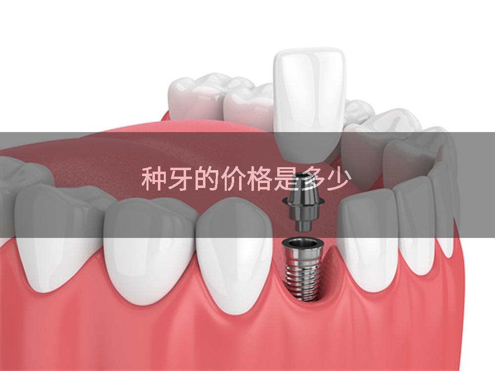 种牙的价格是多少