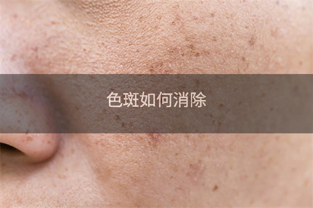 色斑如何消除