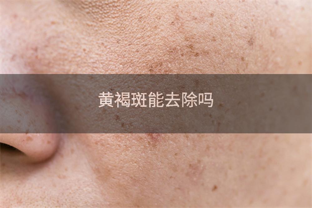 黄褐斑能去除吗