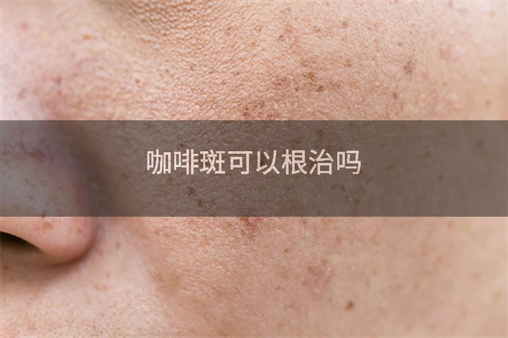 咖啡斑可以根治吗