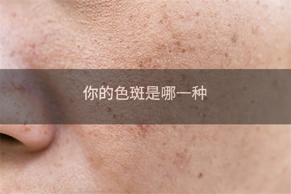 你的色斑是哪一种