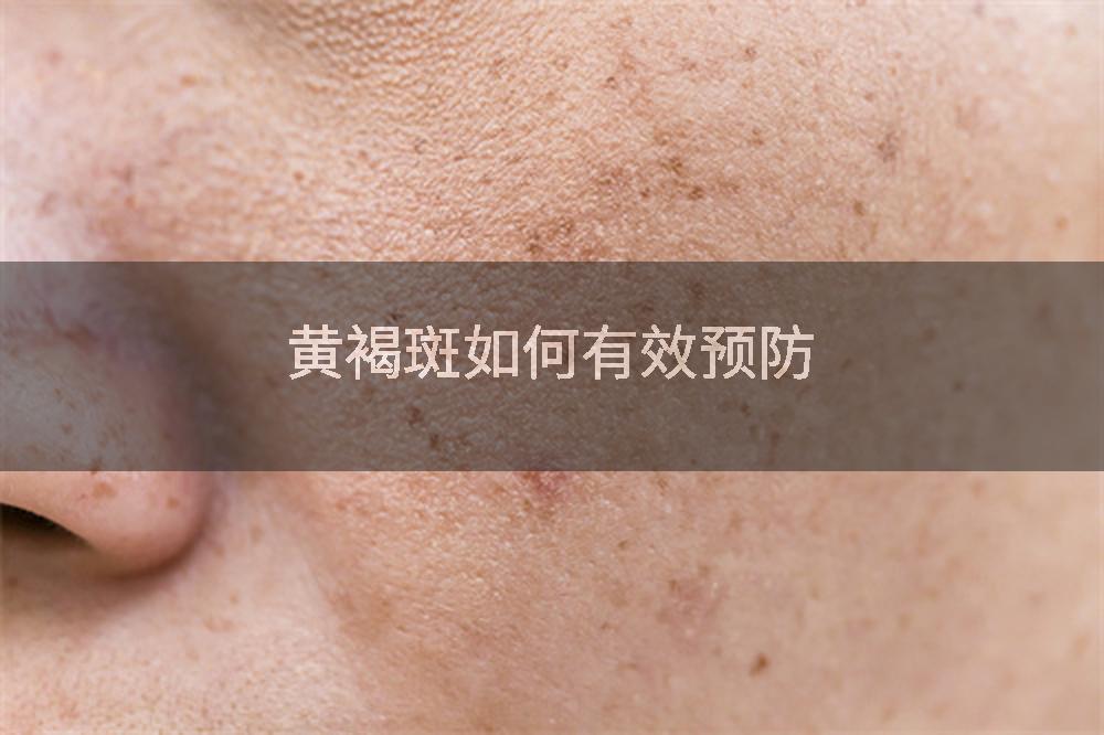 黄褐斑如何有效预防