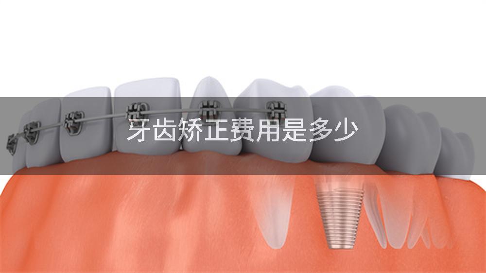 牙齿矫正费用是多少