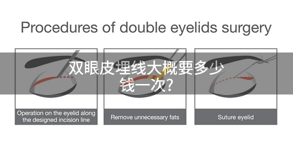 双眼皮埋线大概要多少钱一次?