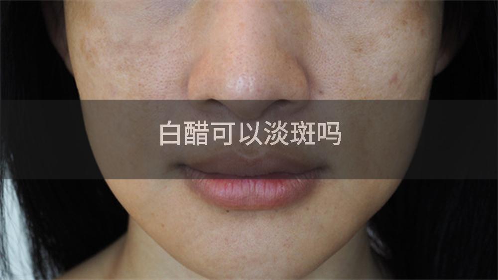 白醋可以淡斑吗